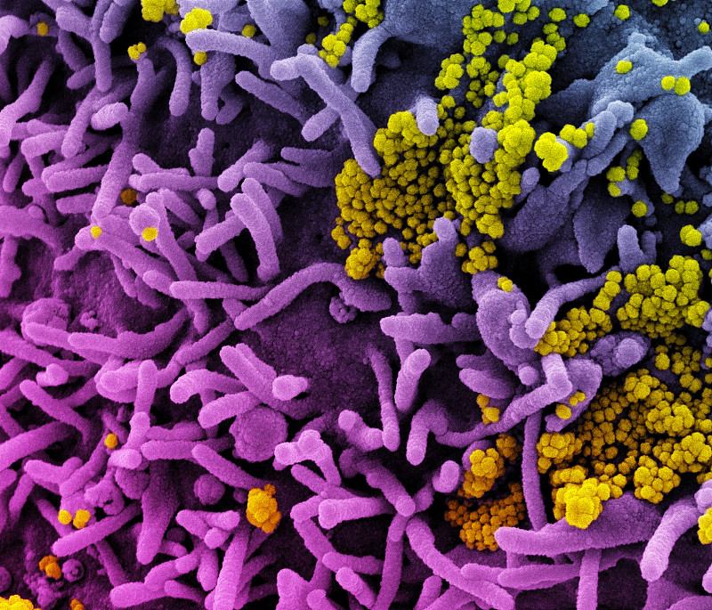 感染sars-cov-2病毒颗粒(黄色)的细胞扫描电镜染色图(紫色).图片