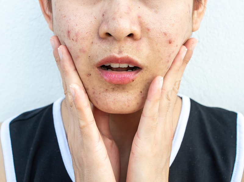 特寫的女人半臉的問題痤瘡炎癥(丘疹和膿皰)在她的臉上。圖片素材