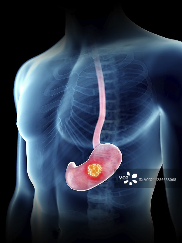 一个男人的胃肿瘤的插图图片素材