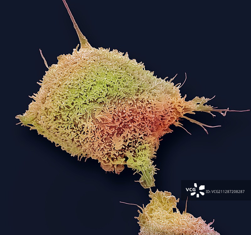 子宫颈癌细胞，SEM图片素材