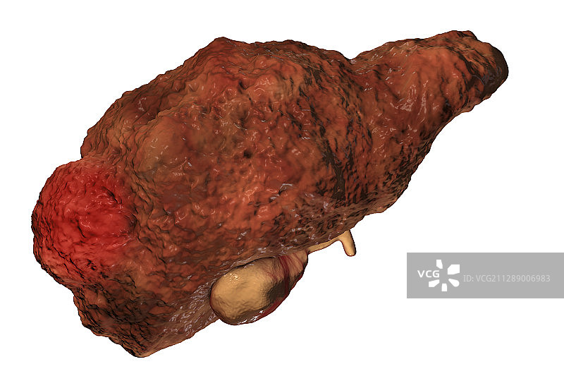 肝硬化伴肝细胞癌，图示图片素材
