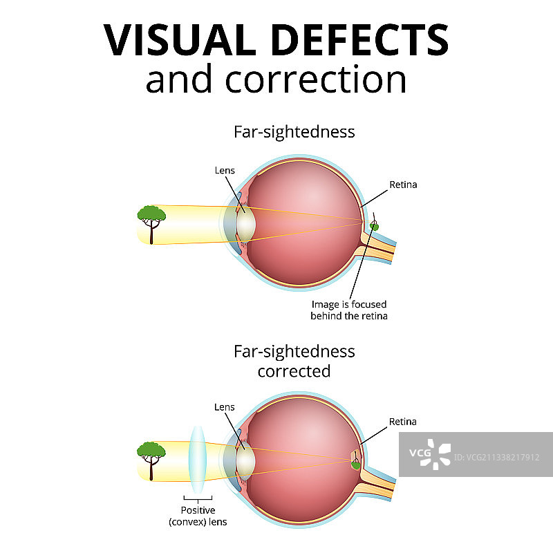 结构眼球视力障碍图片素材