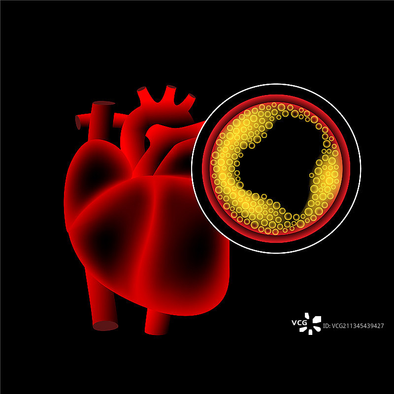 胆固醇心脏病图片素材