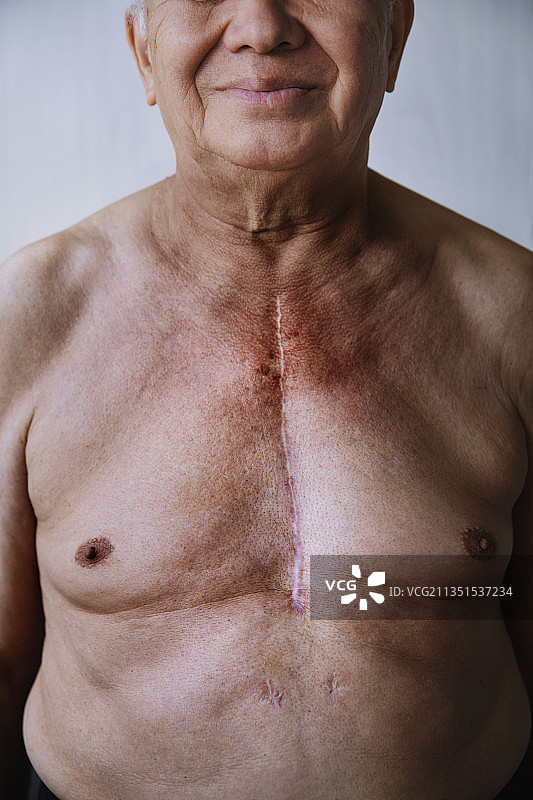 一个胸部有手术疤痕的老人图片素材