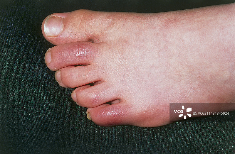 一个六岁女孩脚趾上的冻疮图片素材
