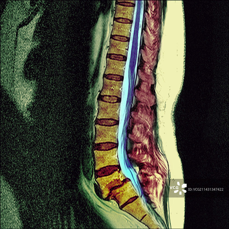 椎体滑移，MRI扫描图片素材
