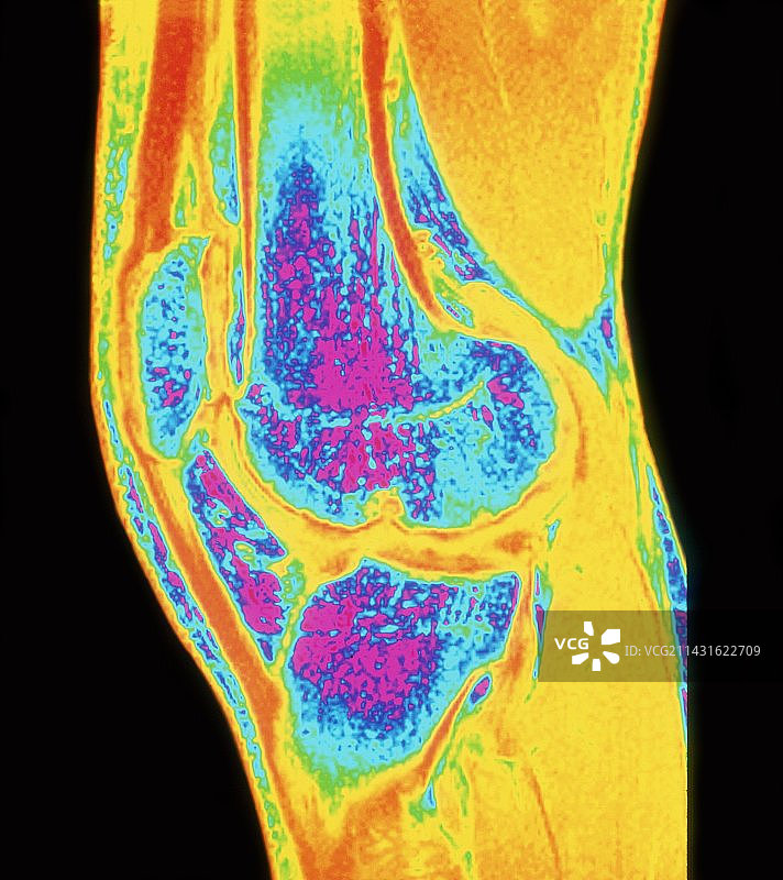 膝关节骨关节炎彩色MRI扫描图片素材