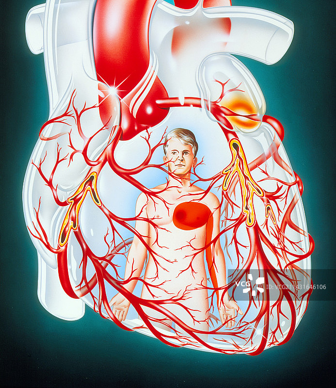 心绞痛病因的心脏图示图片素材