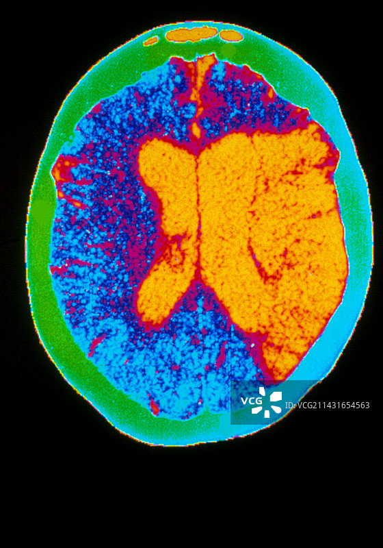 脑出血的彩色CT扫描图片素材