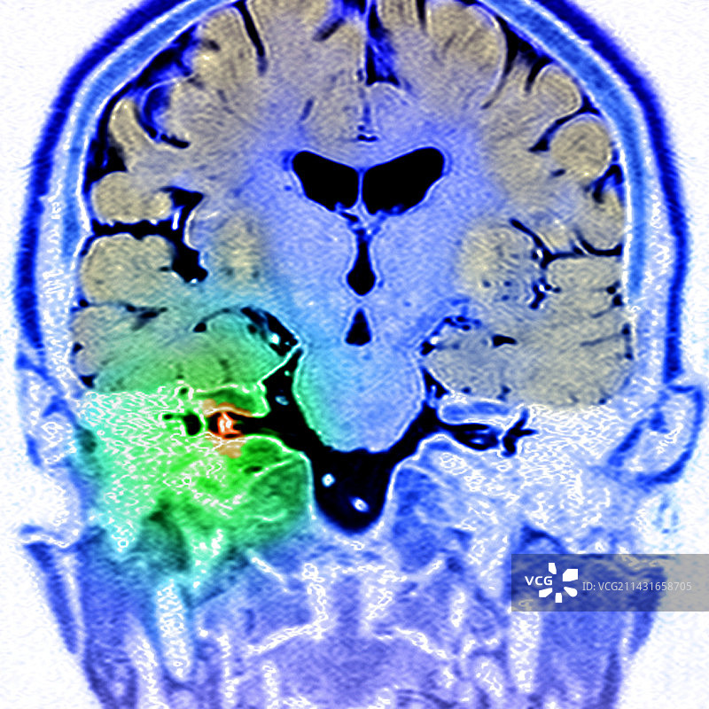 听神经瘤，MRI扫描图片素材