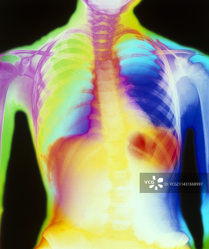 彩色胸片显示肺炎图片素材