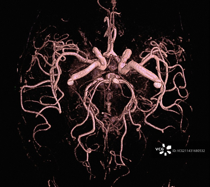 大脑动脉，磁共振血管造影图片素材