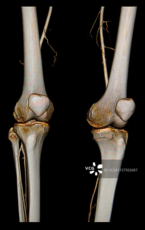 3D额部CT扫描膝关节股动脉图片素材