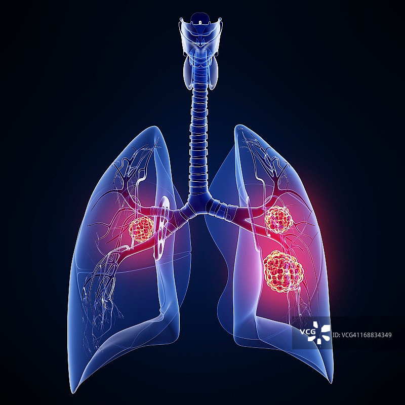 肺癌,艺术品图片素材