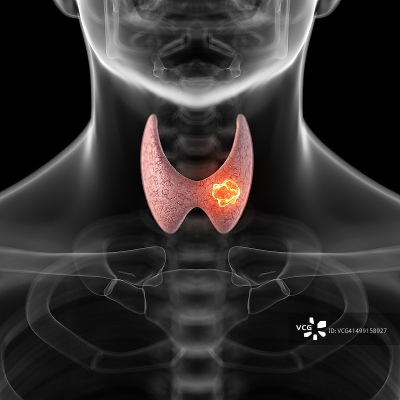 人类甲状腺肿瘤，插图图片素材