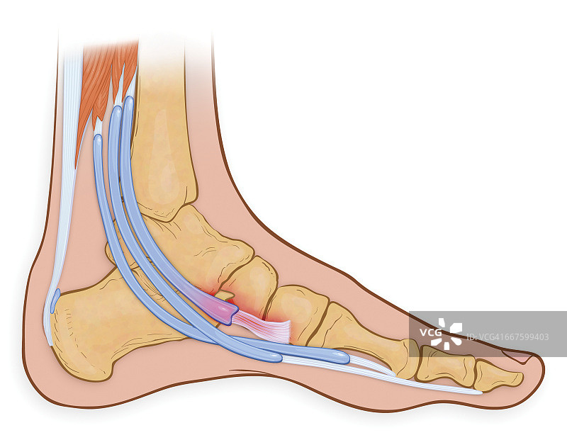 足的内侧视图显示发炎和磨损的胫骨后肌腱图片素材