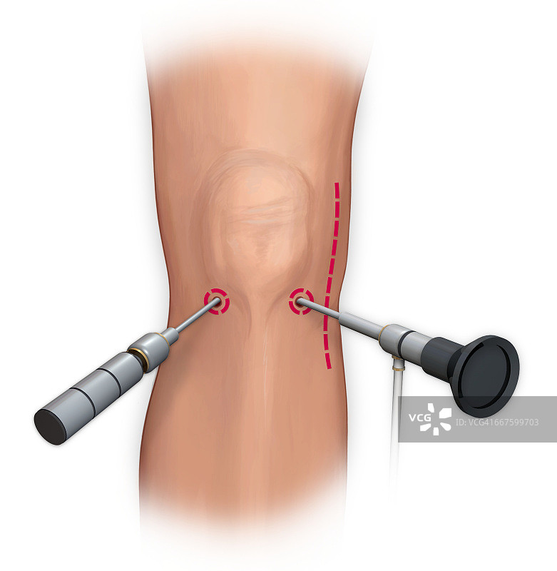 膝关节的关节镜手术修复图片素材