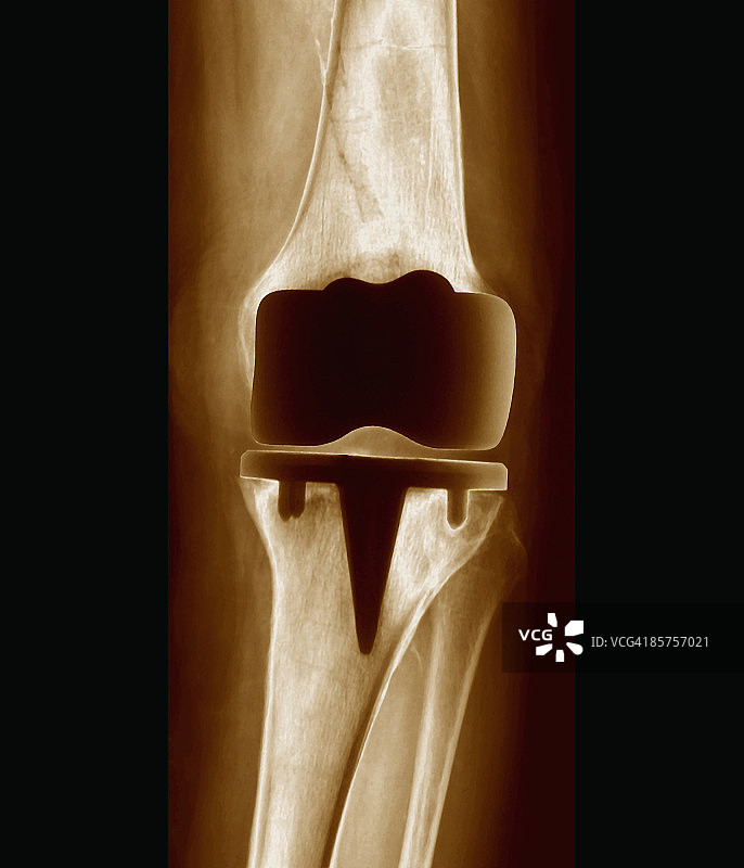 膝关节假体图片素材