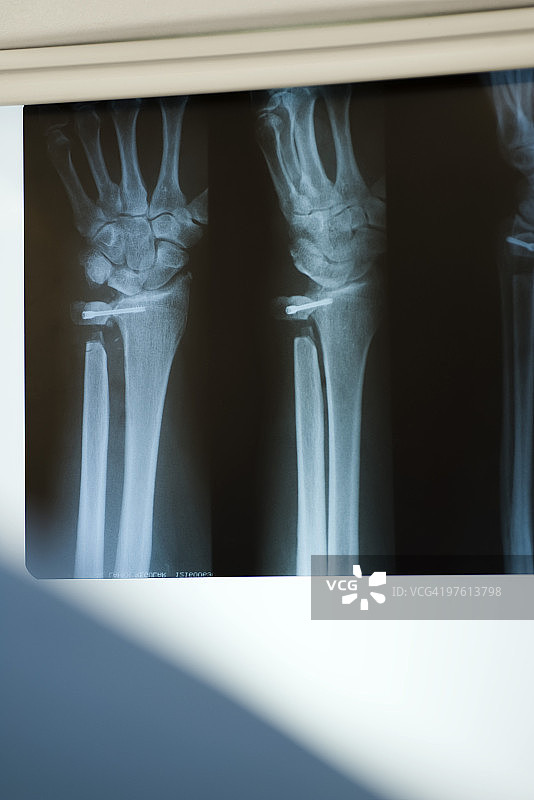 x光显示受伤的桡骨和尺骨图片素材