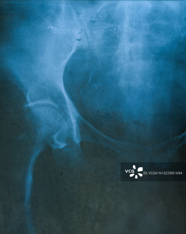 骨盆x射线胶片图片素材