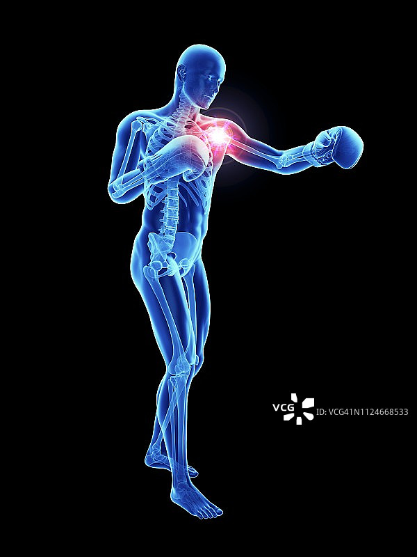 一个运动员肩膀疼痛的插图图片素材