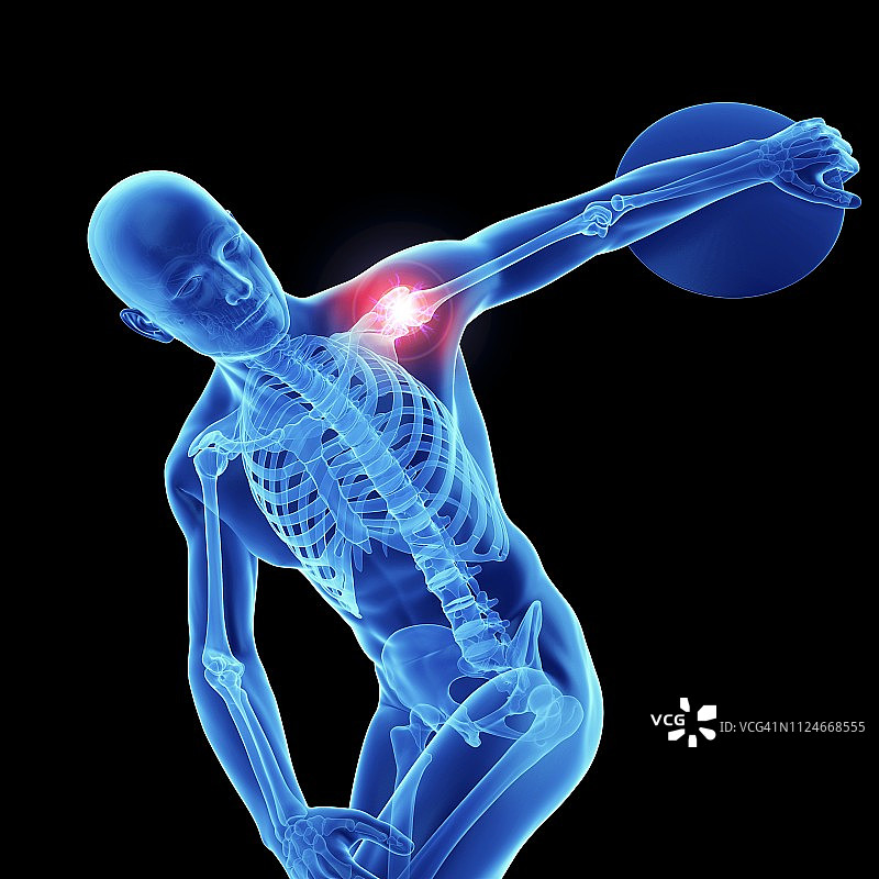 一个运动员肩膀疼痛的插图图片素材