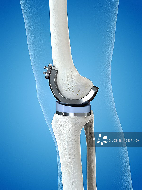 膝关节置换术的插图图片素材