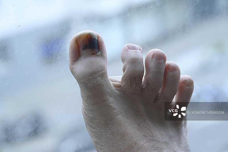 一个人的脚趾受伤了。脚靠近一扇玻璃窗。图片素材