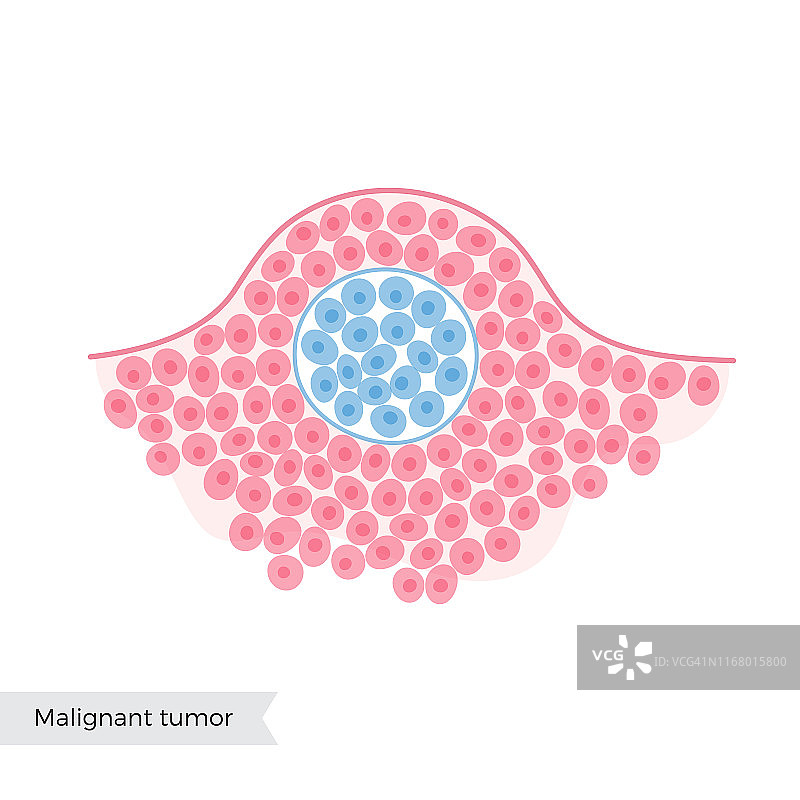 良性肿瘤的载体分离插图图片素材