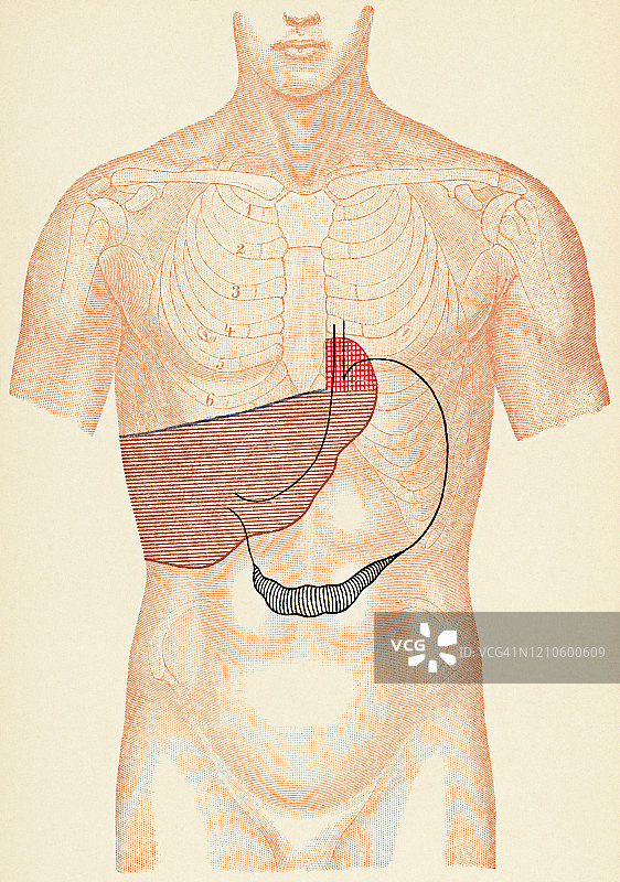 人体躯干与打击检查点的一个病人胃癌和转移性肝病的医学说明，正面视图- 19世纪图片素材