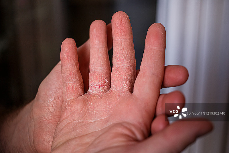 手触碰非常干燥，因使用酒精清洗导致脱皮。水平接近一个非常疼痛，干燥，龟裂的男性手的内部与剥落的皮肤图片素材