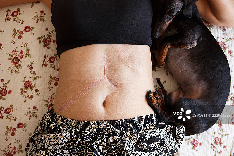 一位妇女俯下身，展示她的肝移植疤痕图片素材