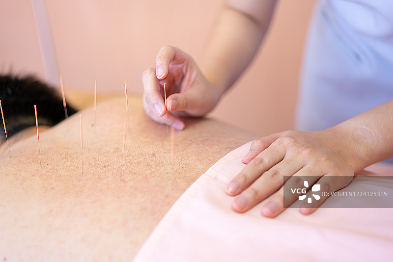 中医针灸针治疗背部止痛由医生图片素材