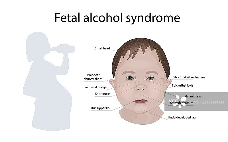 胎儿酒精综合症，说明图片素材