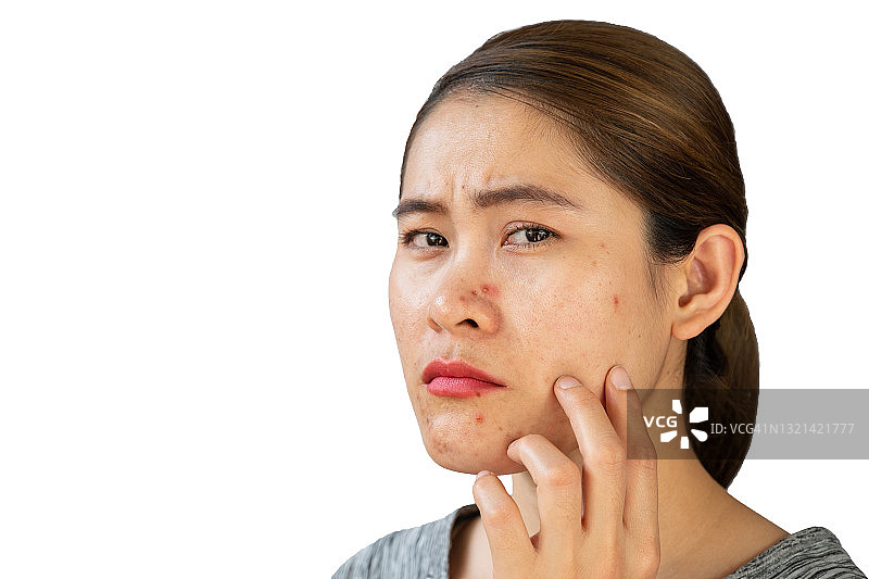 肖像担忧亚洲妇女的问题痤疮炎症(丘疹和脓疱)发生在她的脸上。图片素材