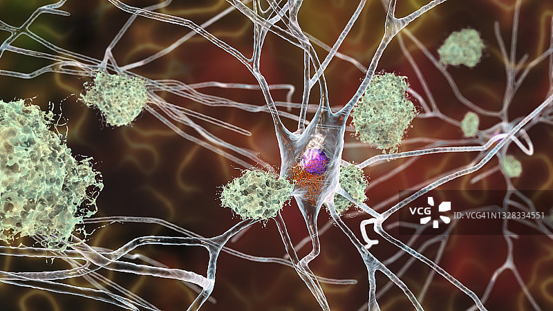 受阿尔茨海默病影响的神经细胞，说明图片素材