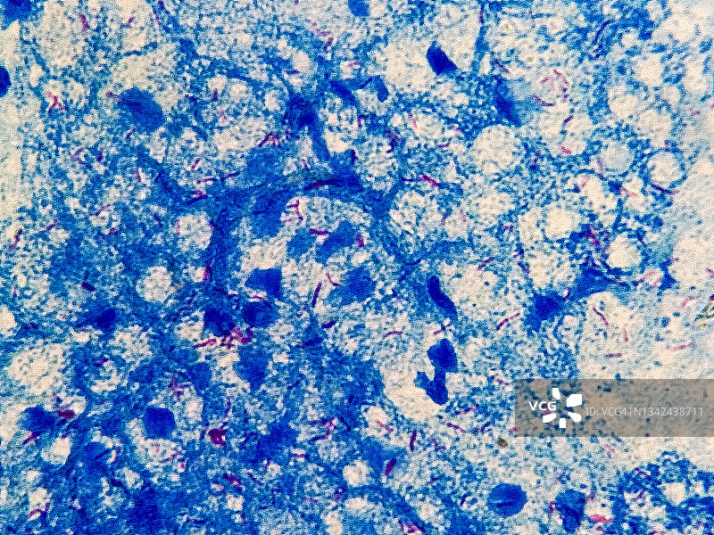 痰涂片AFB染色显微镜下100x显示大量结核大杆菌。图片素材