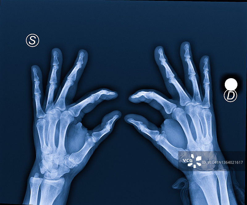 x射线的手图片素材