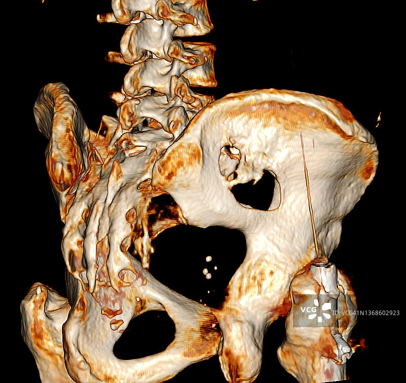 骨盆三维CT扫描显示转移性肿瘤溶骨性病变图片素材