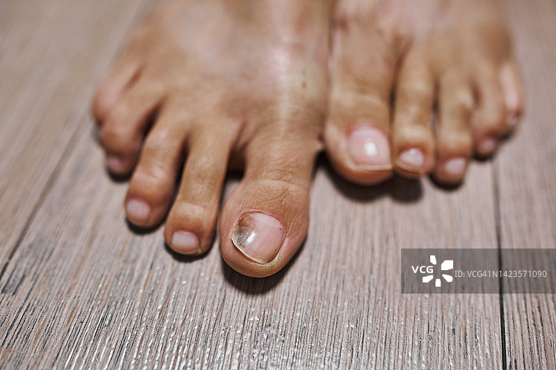 女性脚的特写与疼痛的指甲图片素材