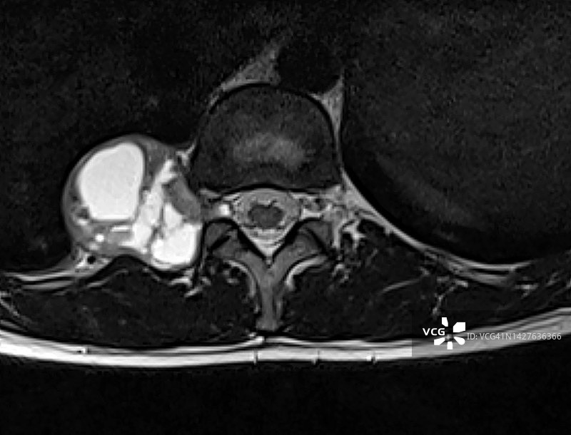 腰椎囊性神经鞘瘤MRI(核磁共振成像)，轴位视图图片素材