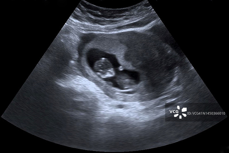 胎儿10周，超声波扫描图片素材