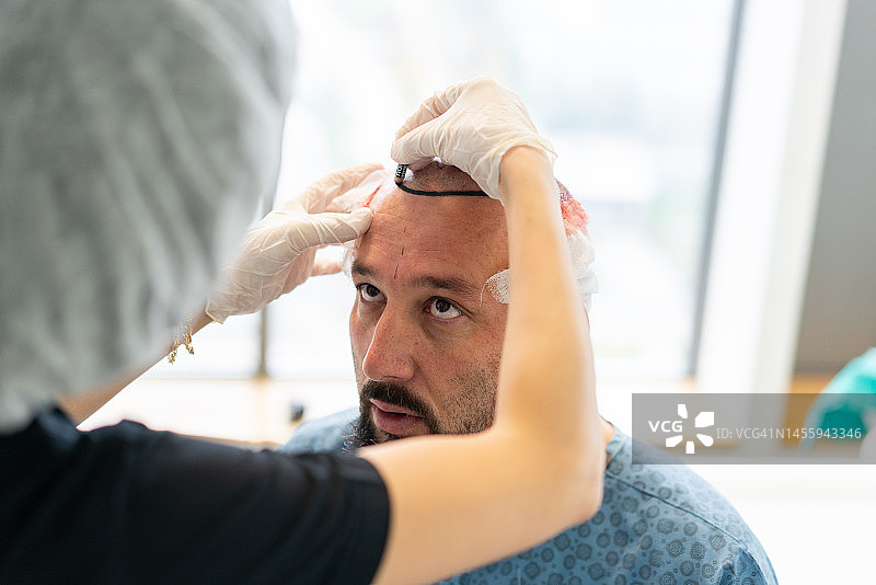 植发手术，整个过程是串联的图片素材