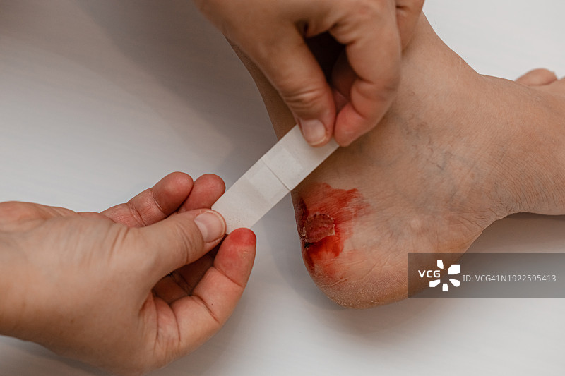 一名女子在摄影棚里光着脚摆姿势，拿着石膏，准备在脚踝流血的伤口上缠上绷带——这是不合脚鞋造成的不适的有力象征。图片素材