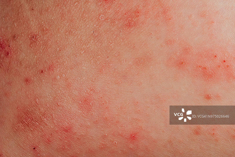 特应性湿疹人体皮肤过敏纹理图片素材