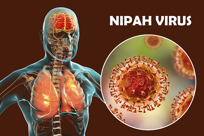 尼帕病毒引起的脑炎，说明图片下载