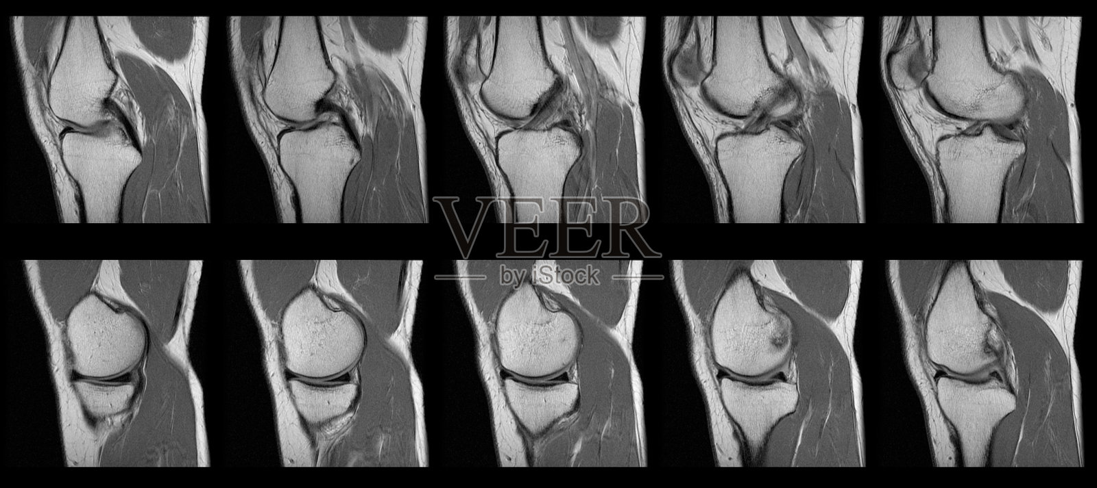撕裂前交叉韧带MRI膝关节扫描系列-成年女性照片摄影图片