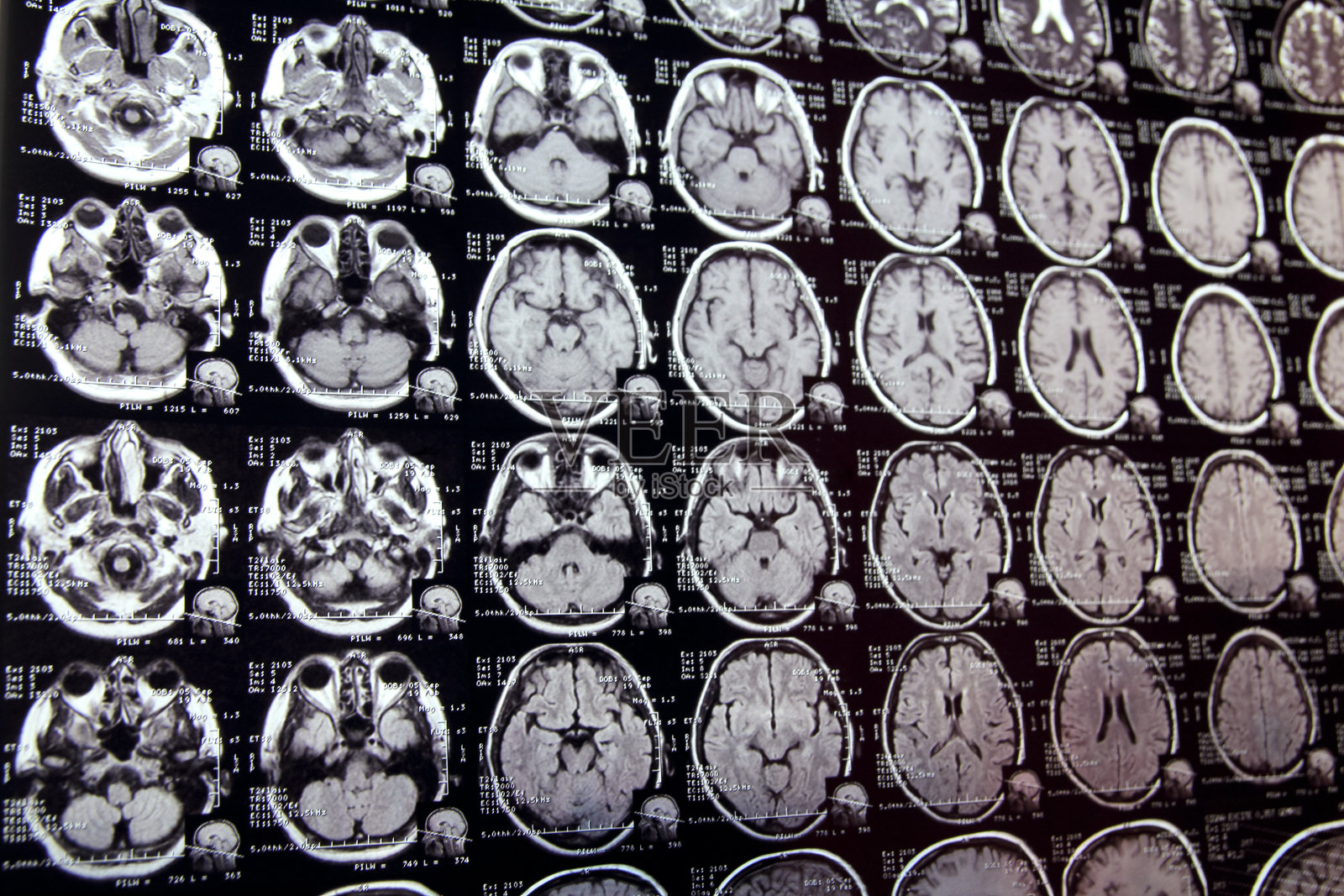 头部MRI扫描的近景照片摄影图片