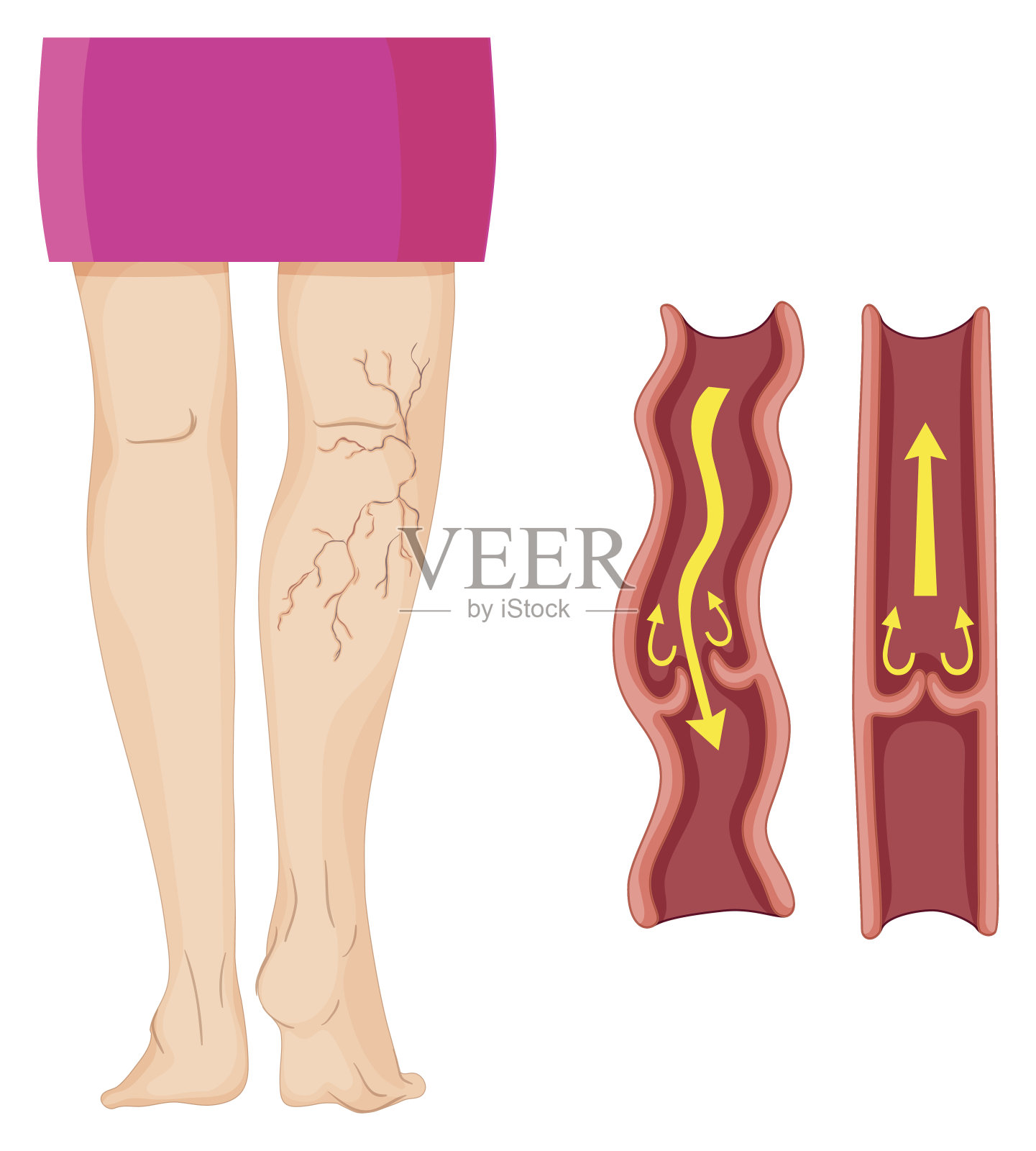人类腿部静脉曲张插画图片素材