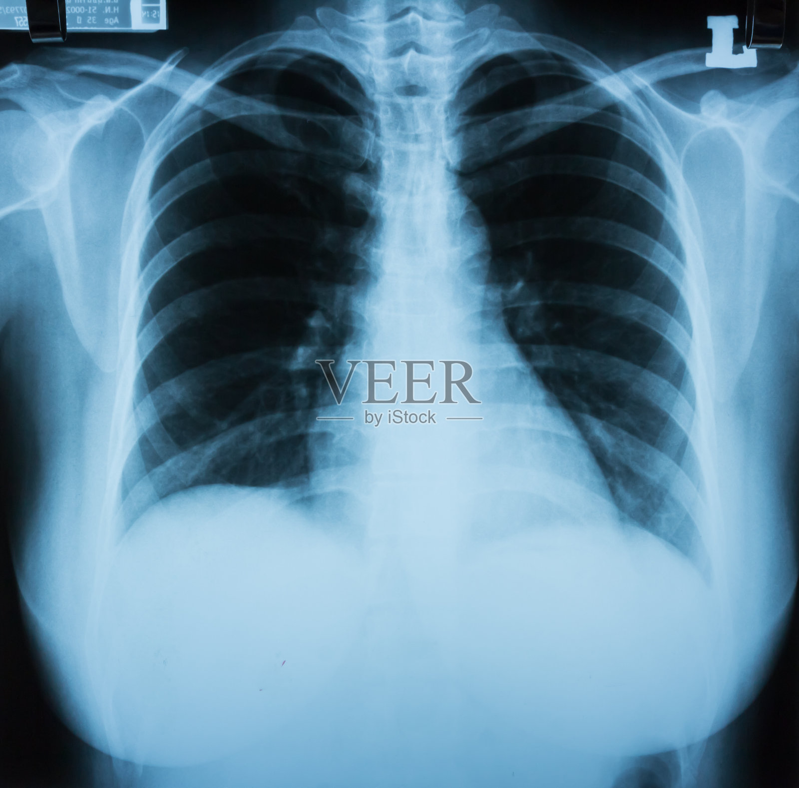 正常的胸部x光片照片摄影图片